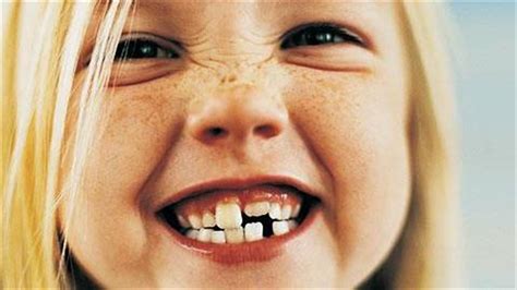 Τι να κάνω αν το παιδί μου έχει στραβά δόντια