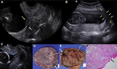 Ultrasound Differential Diagnosis Between Amniotic Fluid Sludge And