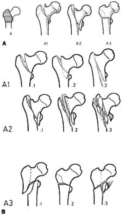 They may affect the neck, shaft or distal (supracondylar) intracapsular neck of femur fractures are graded by various classifications, including garden's classification3 AO/OTA classification of proximal femur fracture AO/OTA ...