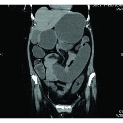 Computed Tomography Ct Abdomen Without Contrast Showing A Coronal