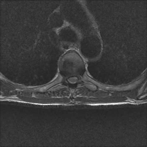 Transient Paraparesis As A Consequence Of Spontaneous Spinal Epidural