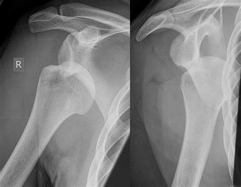Filedislocated Shoulder X Ray 03png
