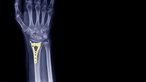 Film Xray Wrist Radiograph Show Lower End Of Forearm Bone Broken