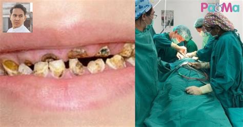 Sehingga jika ada kerusakan gigi susu yang parah dapat mengganggu proses pembentukan gigi tetapnya. Viral 18 Batang Gigi Susu Tinggal Tunggul Dicabut, Anak ...