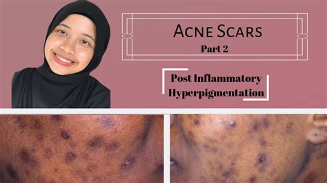 Acne Scars Part 2 Post Inflammatory Hyperpigmentation Youtube