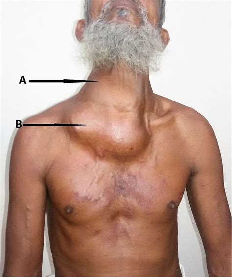 A Case Of Pulsating Sternal And Clavicular Metastases Of