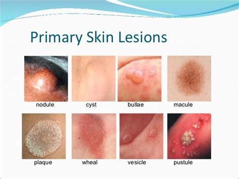 Skin Lesions Skin Dermatology Nurse Skin Disorders