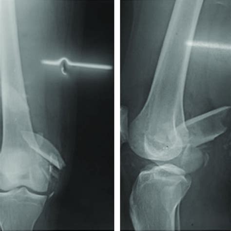 Pdf Medial Femoral Condyle Fracture Following Traumatic Allogenic