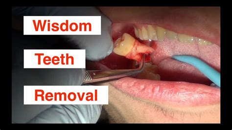 After your wisdom teeth have been removed, you may have swelling and. Wisdom Teeth Removal - YouTube