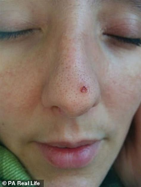kecanduan berjemur wanita ini temukan jerawat kecil di hidungnya sering berdarah hingga divonis