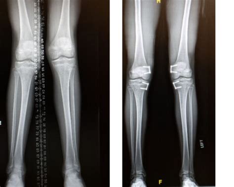 Guided Growth Surgery Helps Teen With Knock Knees Inside Childrens Blog