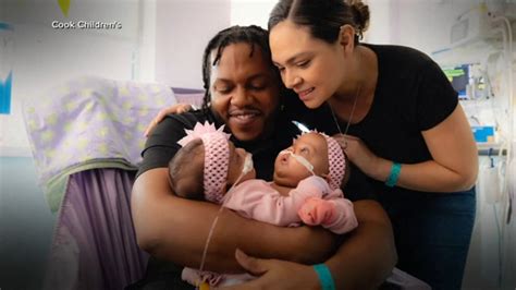 Conjoined Twins Texas 3 Month Old Sisters Successfully Separated After 11 Hour Surgery At Cook
