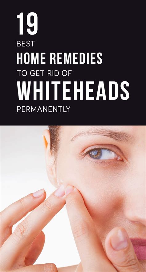 How To Get Rid Of Whiteheads Naturally At Home Skin Care Pimples