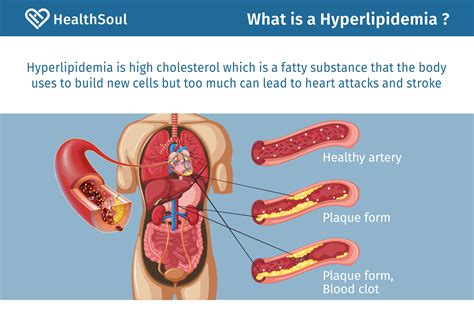 Hyperlipidemia Or High Cholesterol Causes Diagnosis And Treatment Healthsoul