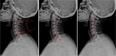 Cervical Sagittal Alignment As A Predictor Of Adjacent Level Ossificat