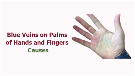 Blue Veins On Palms Of Hands And Fingers Causes