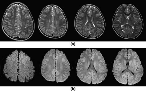 Mri Findings In X Linked Charcotmarietooth Disease Associated With A