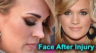 Carrie Underwood’s Face After Injury: What Fans Could Expect To See ...