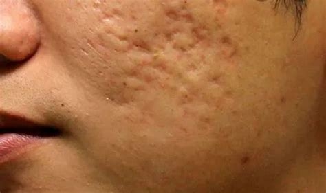 Post Acne Scar Treatment To Reduce Scars With Fat Grafting And Scar