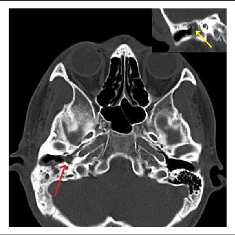 High Resolution Computed Tomography Hrct Temporal With Soft Tissue