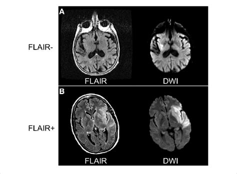 Comparing Diffusion Weighted Imaging Dwi And Flair Sequences To Download Scientific Diagram