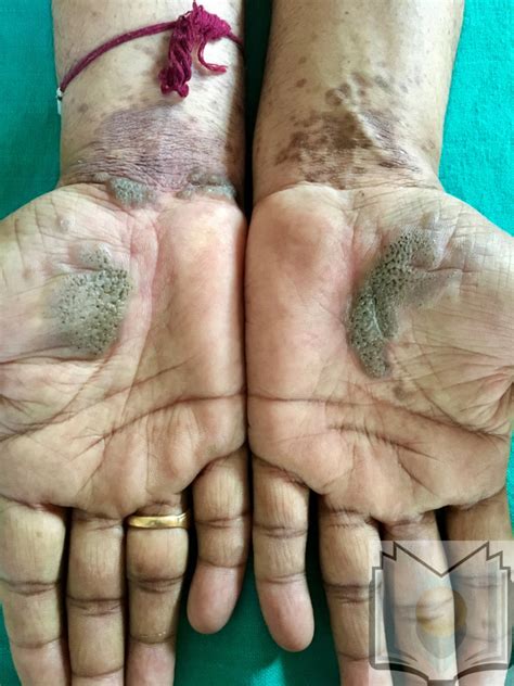 Figure Lichen Planus Palms Contributed By Dr Shyam Verma Mbbs Dvd Frcp Faad Vadodara
