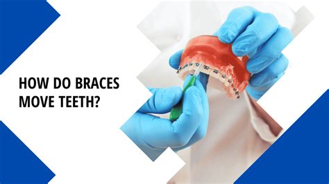 How Do Braces Move Teeth Orthodontic Specialists