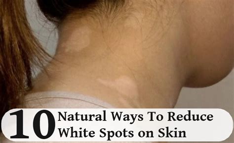 10 Natural Ways To Reduce White Spots On Skin Search Herbal And Home Remedy