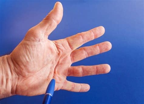 Dupuytrens Contracture An Early Stage Cure That Makes Living Life