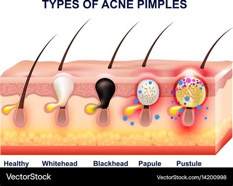 Diagram Of A Pimple