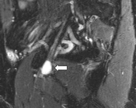 Mr Imaging Of Entrapment Neuropathies Of The Lower Extremity