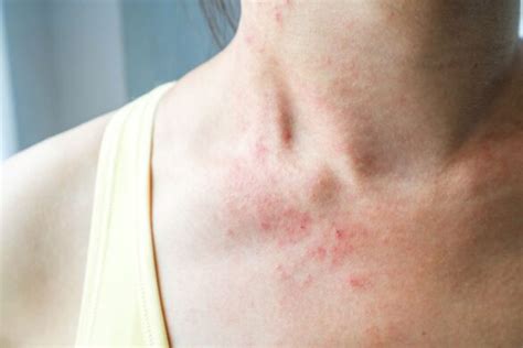 Rash On Neck Meaning Causes Itchy Red Bumpy Rash Diagnosis And Treatments American Celiac