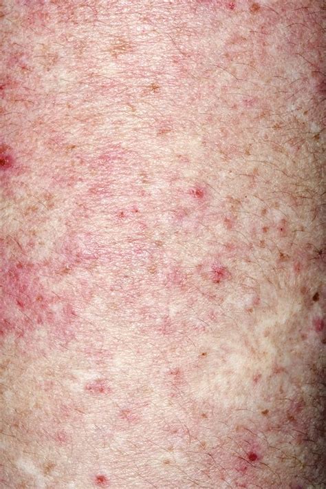 Rash After Steroid Use Stock Image C0269218 Science Photo Library