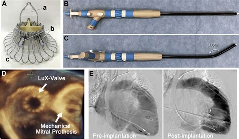 Transcatheter Tricuspid Valve Replacement For Anderson Fabry Disease