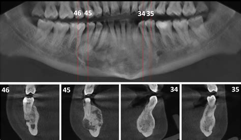 Fibroma Osificante En La Parte Anterior De La Mandíbula Dento Metric