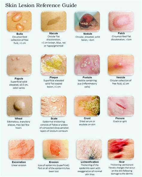 Skin Lesion Reference Guide Medschool Doctor Medicalstudent Image