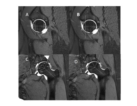 Hip Mr Arthrography T1 Fat Saturation Images With Illustration Of