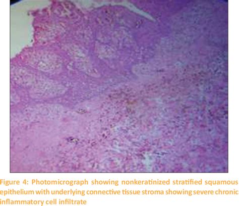 figure 4 from maxillary and mandibular unusually large radicular cyst a rare case report