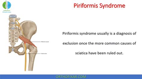 Piriformis Syndrome Orthofixar