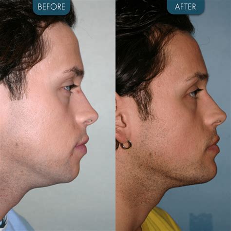 Chin Implant Before And After Zaren Clinic