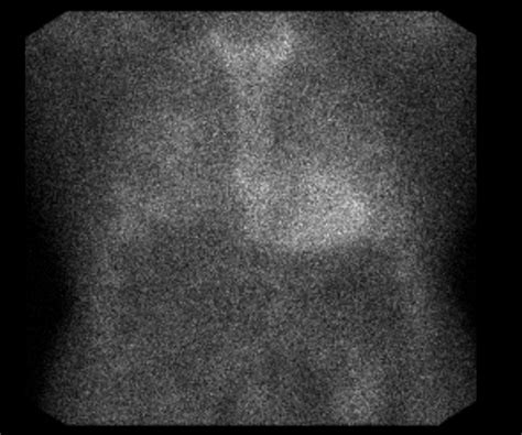 Cureus Ruptured Bullae A Case Of Transthyretin Cardiac Amyloidosis