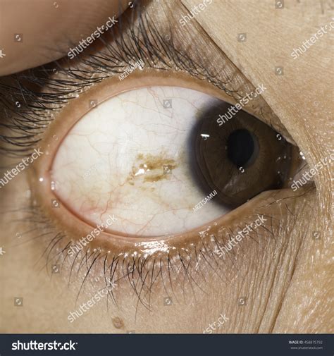 Close Conjunctival Nevi During Eye Examinationc Stock Photo 458875792