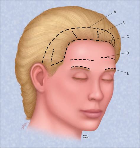 This will make your eyebrows appear much higher. Evaluation of the Midforehead Brow-lift Operation | JAMA ...