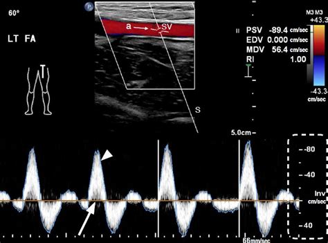 Doppler Ultrasonography Of The Lower Extremity Arteries Anatomy And