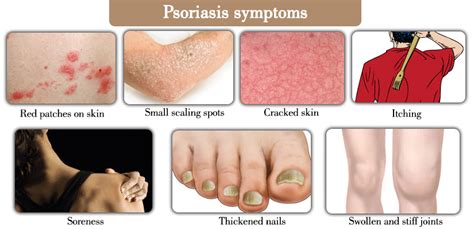 One Day People With Psoriasis May Be Able To Simply Go Online To