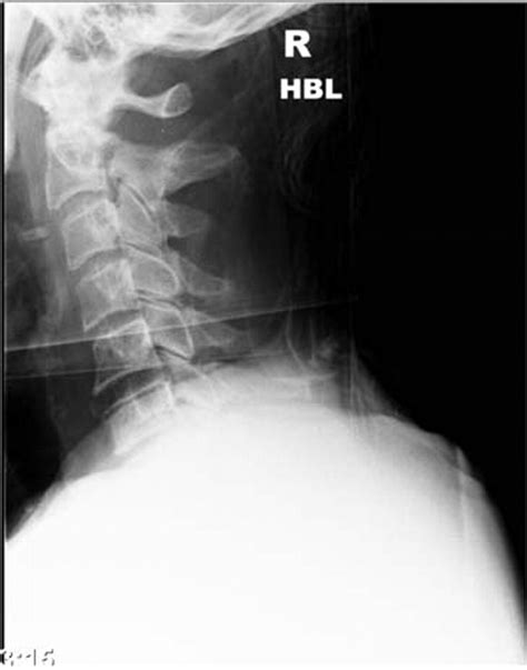 A Potentially Missed Cervical C2 Spine Fracture Bmj Case Reports