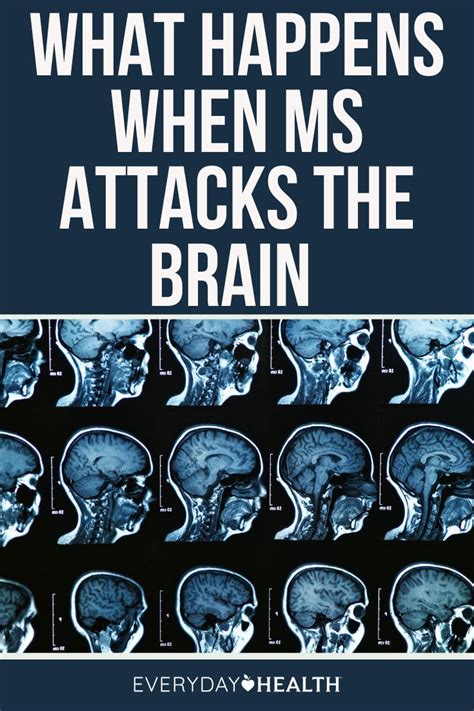 The Damage That Multiple Sclerosis Ms Causes In The Brain Isnt