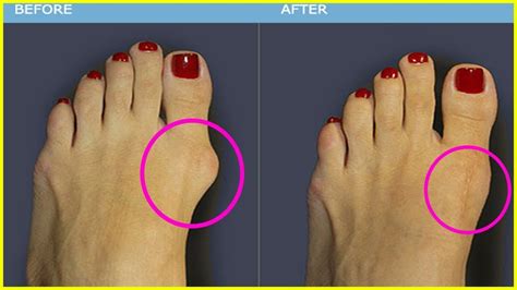 Bunion Pain 10 Ways To Relieve The Pain Of Bunions Youtube