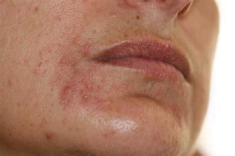 Diseases Of The Sebaceous Glands Perioral Dermatitis Picture