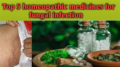 5 Best Homeopathic Medicines For Fungal Infectionhomeopathic Treatment